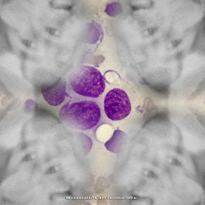 Metastatic-carcinoma-50x