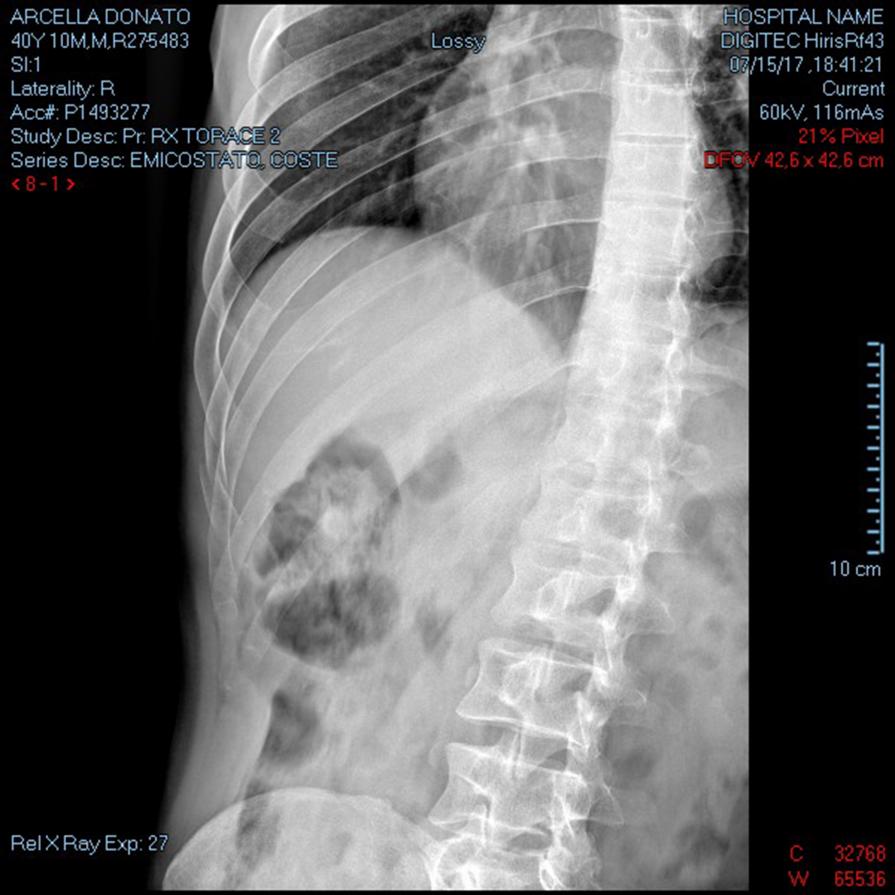 Emitorace DX  ( autoritratto  radiografia )