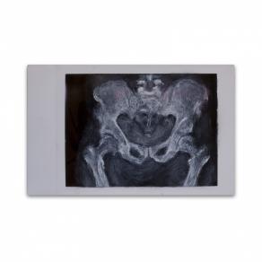 X-ray