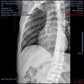 Emitorace DX ( autoritratto radiografia )