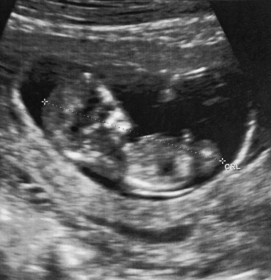 Personal Experience: A baby growing inside my body